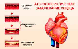 Sirds un asinsvadu slimības: galvenās pazīmes un pirmie simptomi